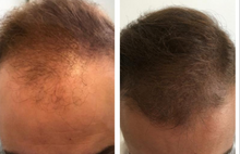 Load image into Gallery viewer, Hair Loss Treatments