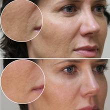 Load image into Gallery viewer, Profhilo