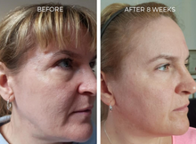 Load image into Gallery viewer, Profhilo